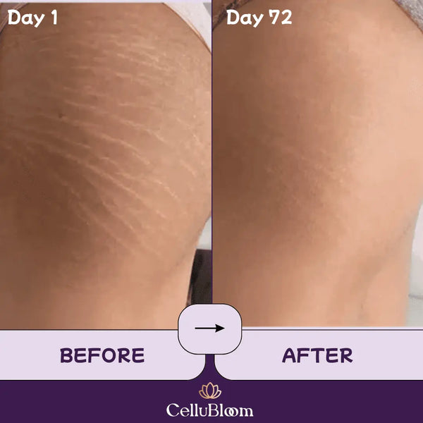 CelluBloom® - Sculpt & Tone Pro CelluBloom